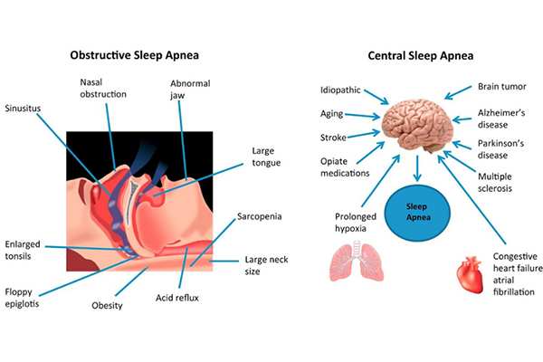 Types of Sleep Apnea